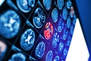 Brain Bleed from Car Accident – Causes & Symptoms